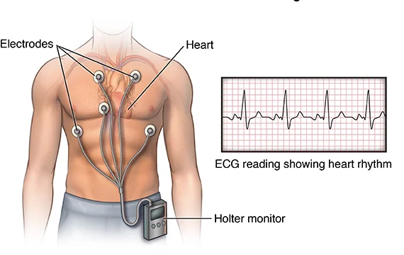 ecg-pIc